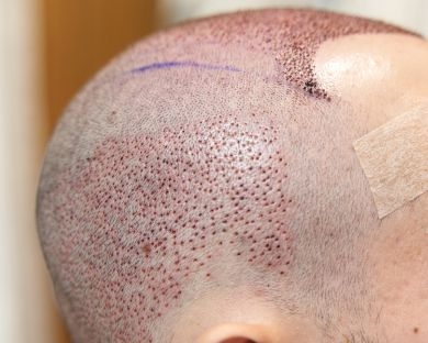 Postoperatorio de un injerto capilar